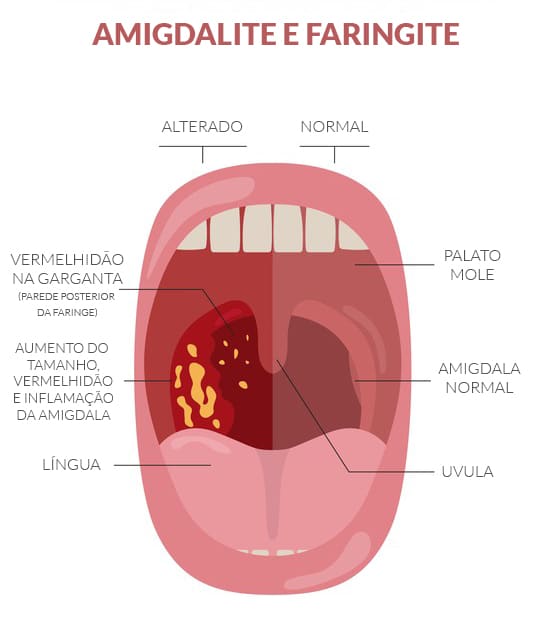 Amigdalite: o que é, sintomas, tratamento - Mundo Educação